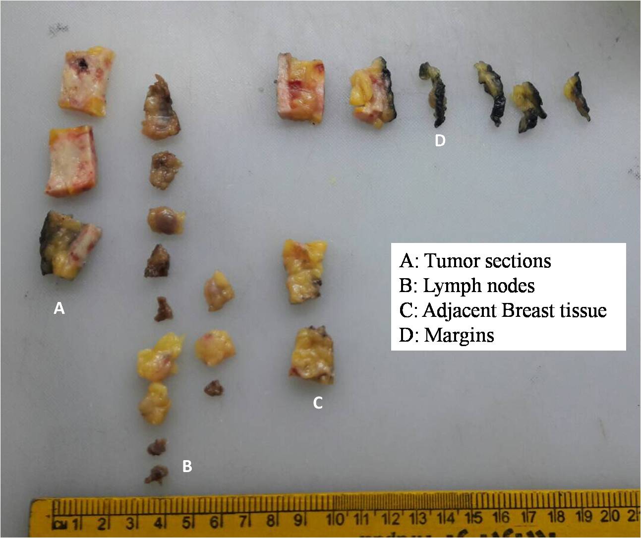 Atlas of breast cancer early detection